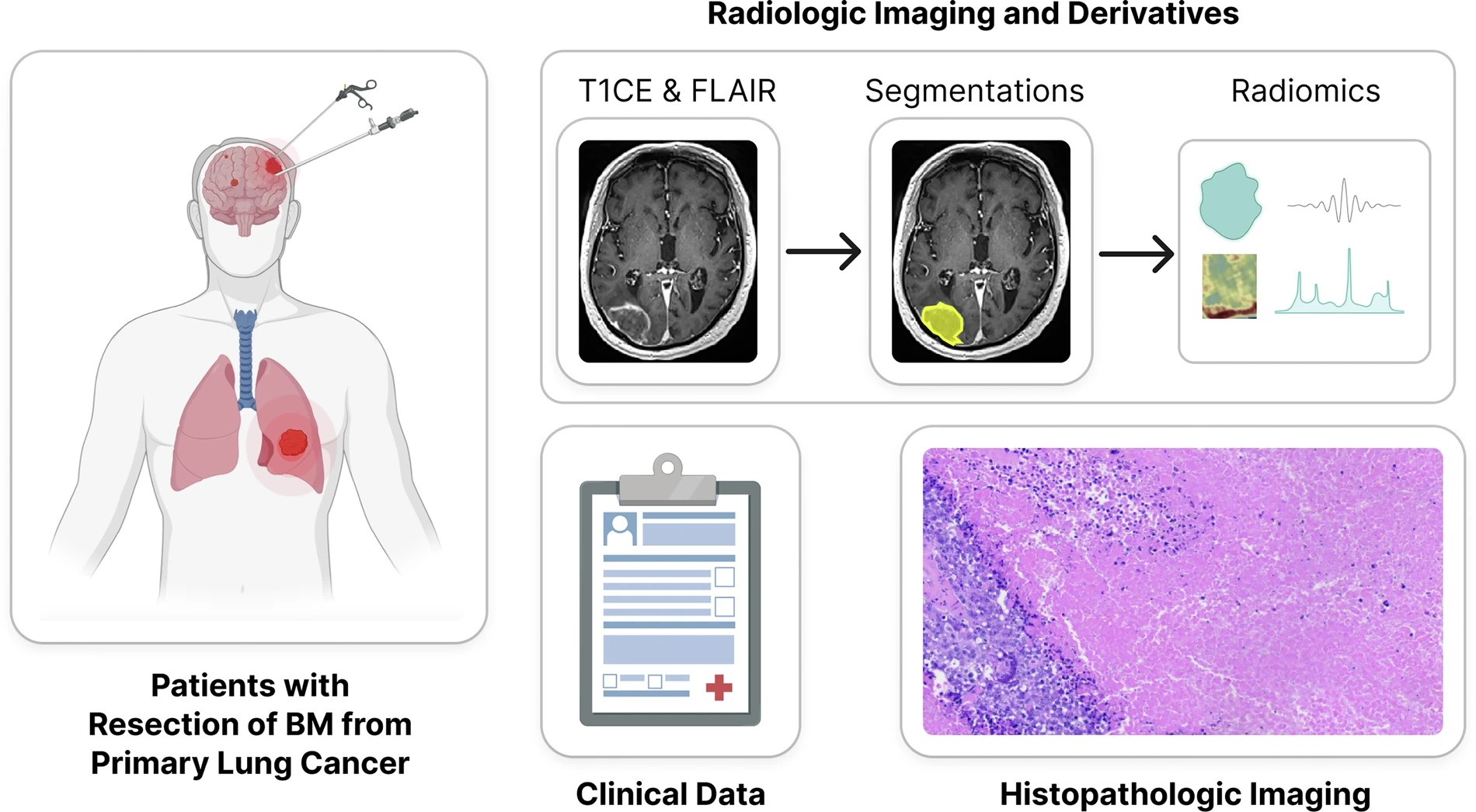 Harnessing AI to Personalize Care for Brain Metastases